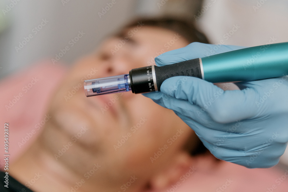 A device for induction therapy with microneedles and collagen on a blurred background of a European man's face 2 A device for induction therapy with microneedles and collagen on a blurred background of a European man's face 2