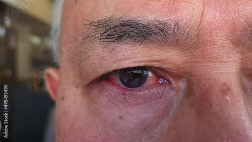 A person with a red inflamed watery eye caused by bacterial infection or a severe reaction of hay fever. photo