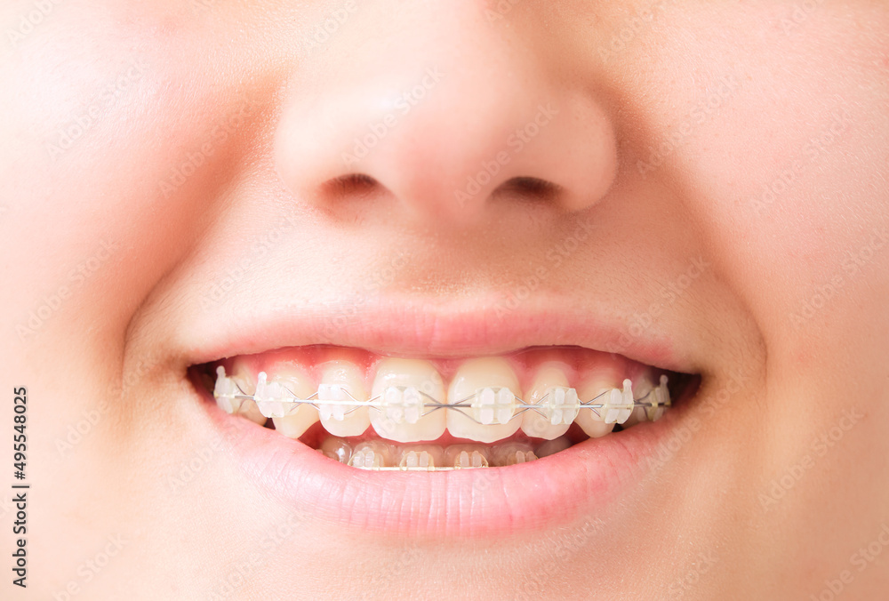 Obraz premium smiling mouth with dental aligner