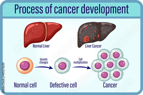 Process of cancer development