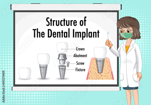 Infographic of human in structure of the dental implant