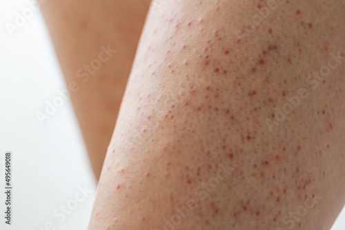 Pillar keratosis on a young woman's legs. Skin peeling with red spots