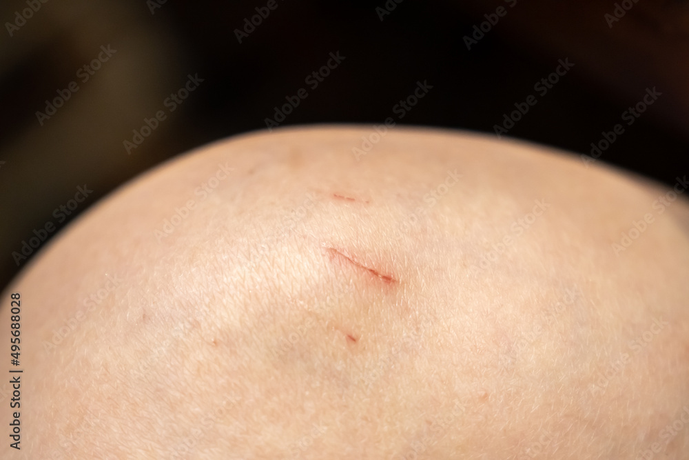 Fototapeta premium A bleeding wound on a broken skin