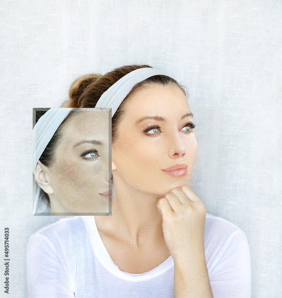 Dark spots, freckles,hyperpigmentation(melasma or chloasma),concept - skin lightening, skin whitening, fruit acids,AHA, Skin Brightening. Dark spots, freckles,hyperpigmentation(melasma or chloasma),concept - skin lightening, skin whitening, fruit acids,AHA, Skin Brightening.