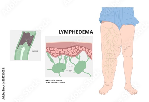 Meige’s syndrome Milroy Leg edema venous Deep vein cancer swelling upper limb wrap calf ulcer meige lymph node arms hand pain cloth blood feet ankle liver kidney heart lung non Nonpitting pedal