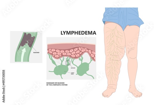 Meige’s syndrome Milroy Leg edema venous Deep vein cancer swelling upper limb wrap calf ulcer meige lymph node arms hand pain cloth blood feet ankle liver kidney heart lung non Nonpitting pedal photo