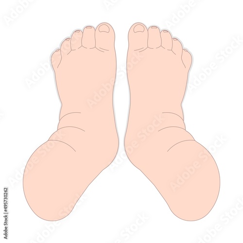 limb swelling syndrome pain Milroy Leg edema venous Deep vein cancer upper wrap calf ulcer meige lymph node arms hand cloth blood feet ankle liver kidney heart lung non Nonpitting pedal