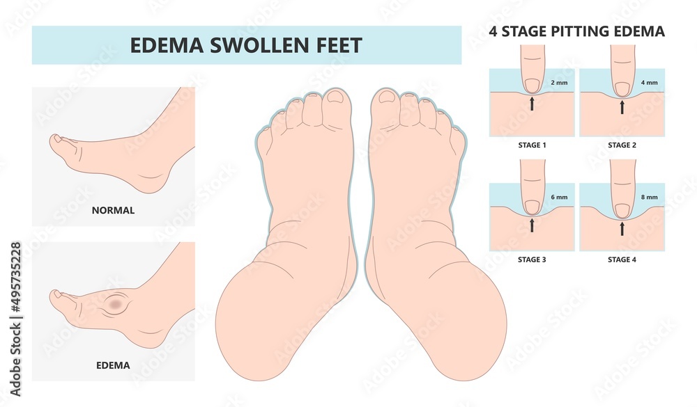 feet ankle swelling Meige’s syndrome Milroy Leg edema venous Deep vein