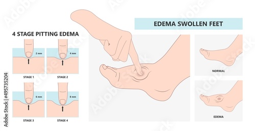 cloth blood feet ankle syndrome Milroy Leg edema venous Deep vein cancer swelling upper limb wrap calf ulcer meige lymph node arms hand pain liver kidney heart lung non Nonpitting pedal