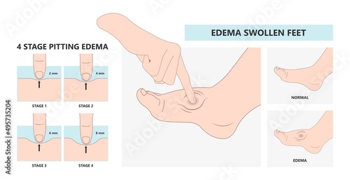 cloth blood feet ankle syndrome Milroy Leg edema venous Deep vein cancer swelling upper limb wrap calf ulcer meige lymph node arms hand pain liver kidney heart lung non Nonpitting pedal photo