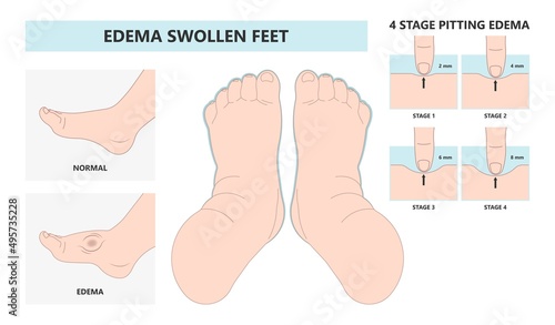 feet ankle swelling Meige’s syndrome Milroy Leg edema venous Deep vein cancer upper limb wrap calf ulcer meige lymph node arms hand pain cloth blood liver kidney heart lung non Nonpitting pedal