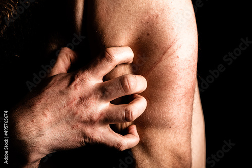 Close up of mans hand and fingers, clawing himself in depression and despair, with scratch marks from self harm.