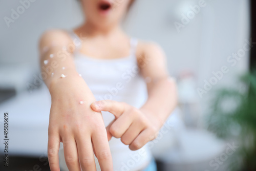 Obraz na plátně Little girl ill with chickenpox  at home, closeup