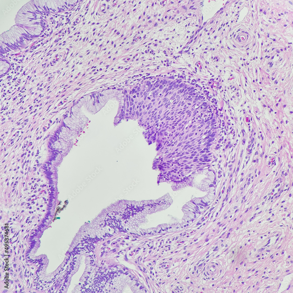 Camera Photo Of High Grade Squamous Intraepithelial Lesion Hsil Involving Endocervical Gland 