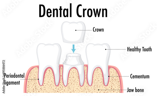 Infographic of human in dental crown