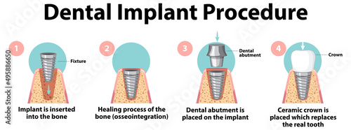 Infographic of human in dental implant procedure