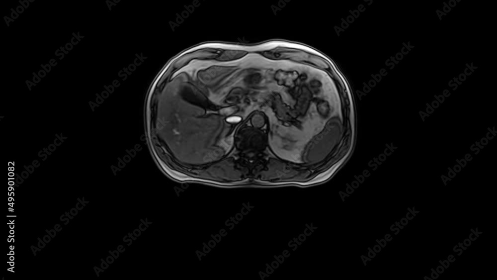 CT scan of the abdomen. Computed tomography of the gastrointestinal tract, liver and kidneys. CT scan of the abdomen. Computed tomography of the gastrointestinal tract, liver and kidneys.