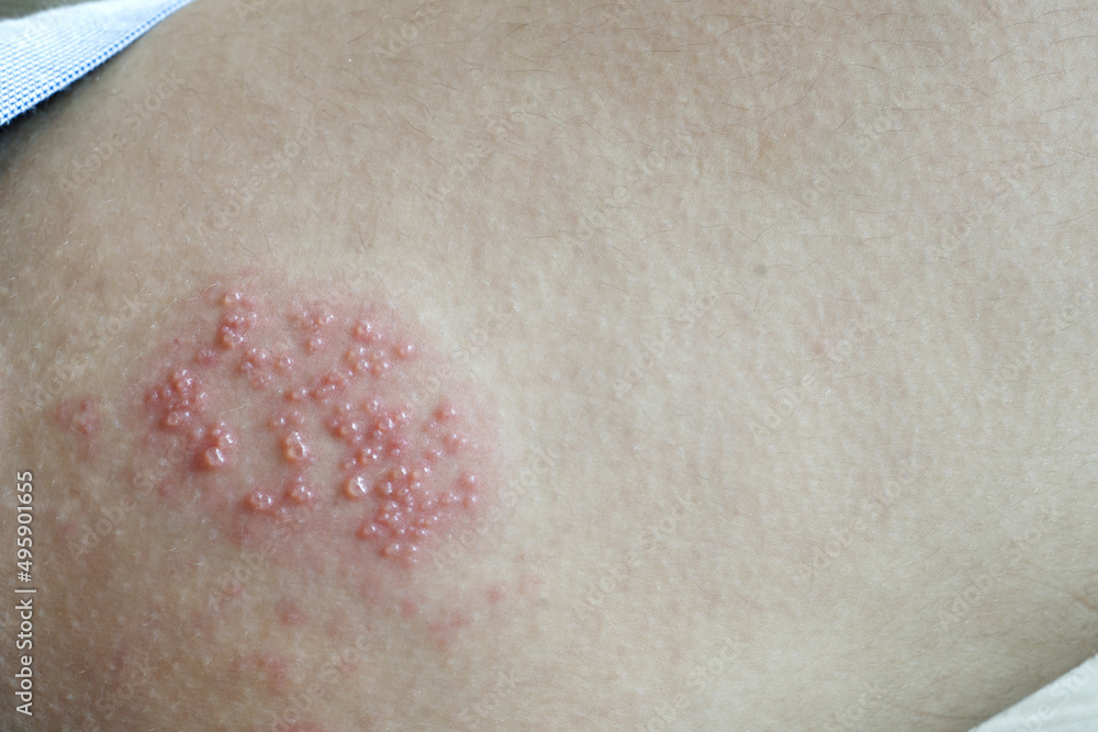 Fototapeta premium The skin of an Asian girl with red spots from shingles in natural light.