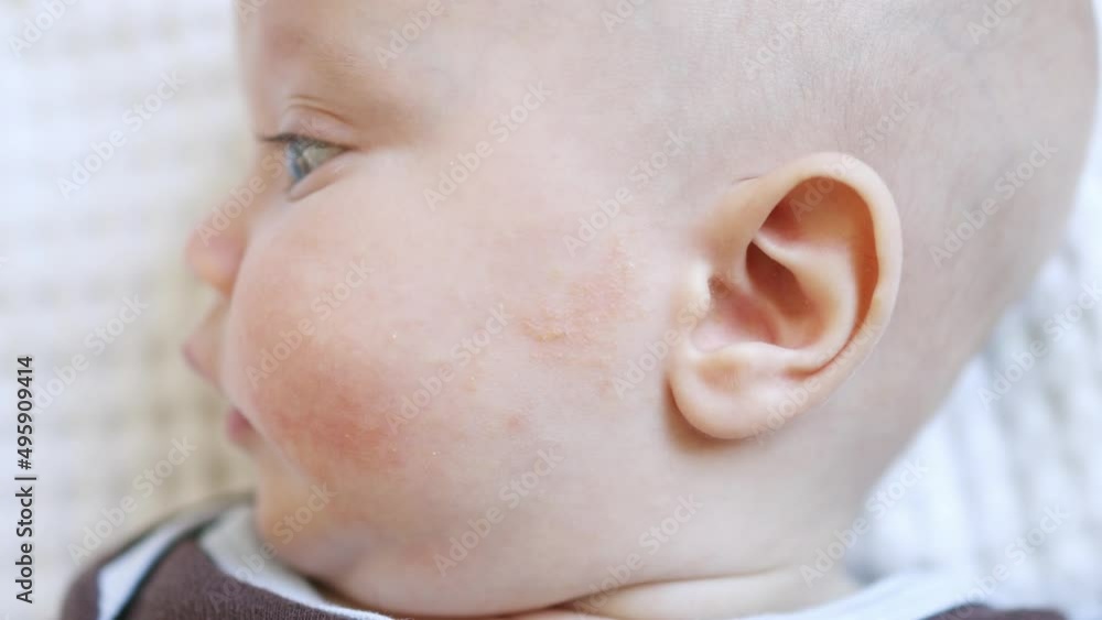 infant baby skin problem dermatitis, allergy, rash, pink irritation