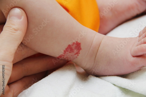 Infant hemangioma on the leg of a little boy photo