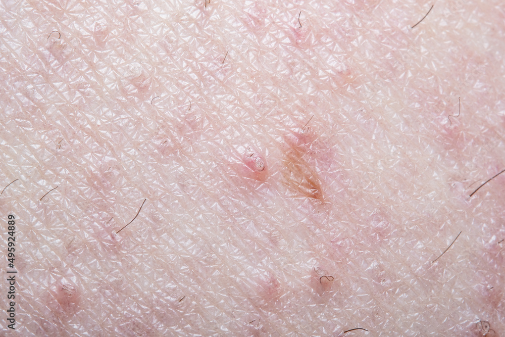 A close-up of a man's skin with damage from ingrown hairs. Photos on the themes of medicine and dermatology in soft focus at high magnification.