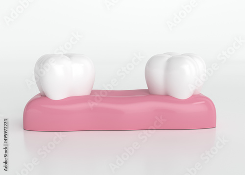 Encima enferma con perdida dental, caída de diente por encías enfermas vista frontal de diente enfermo, ilustración 3d 