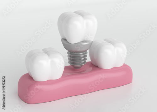 Implante dental unitario, prótesis dental fija, soluciona el problema de perdida de diente, salud oral, vista lateral, ilustración 3D sobre fondo blanco