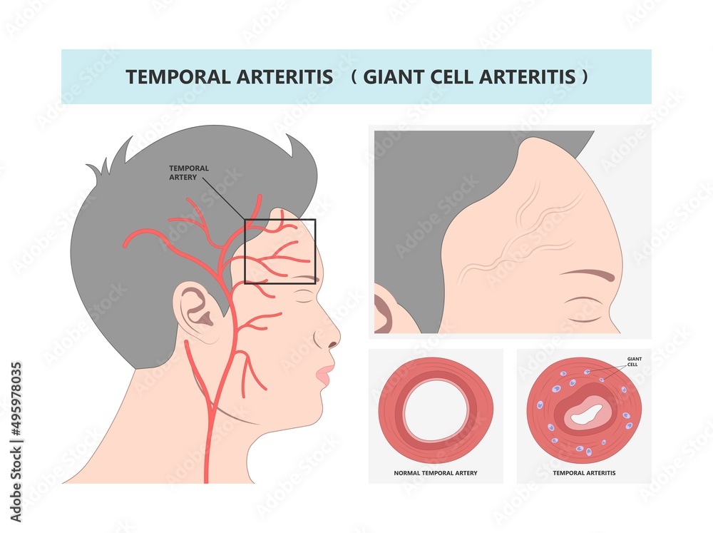 Fototapeta premium Giant cell takayasu blood Horton's artery scalp swollen brain mini stroke Jaw pain Vision loss double blurry anemia older head viral virus bacteria adult Aortic aorta bell palsy eye Carotid Rheumatoid