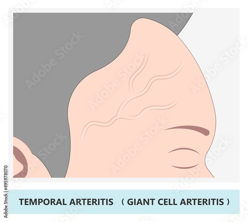 mini stroke carotid artery brain rheumatoid giant cell takayasu blood Horton's scalp swollen Jaw pain Vision loss double blurry anemia older head viral virus bacteria adult Aortic aorta bell palsy eye