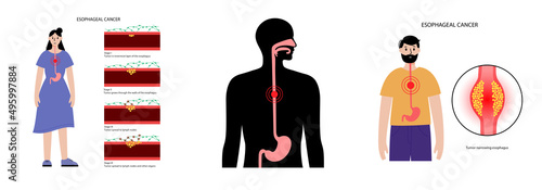 Esophageal carcinoma concept photo