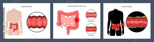 Intestines diseases concept