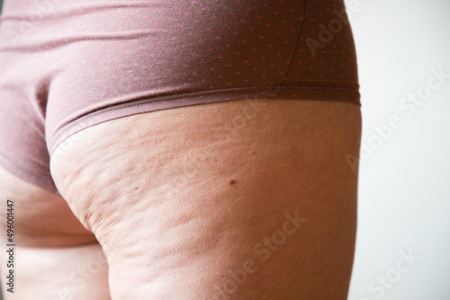 cellulite or orange crust on  feet. Reducing overweight and struggle with cellulite, subcutaneous fat deposition photo