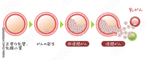 乳がん・乳癌・乳ガン・Breast cancer・浸潤がん・非浸潤がんのイラスト