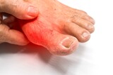 Inflammation of Asian man’s foot. Concept of foot joint pain, stumble, arthritis, hyperuricema or gout.