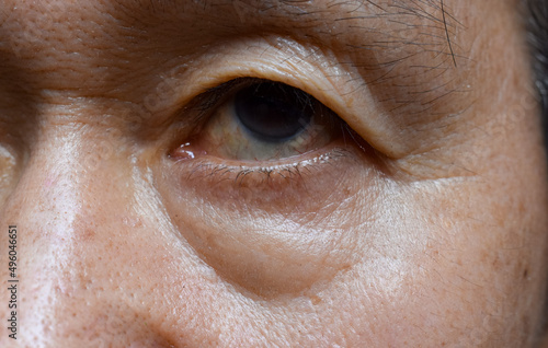 Prominent fat bag and wrinkles under eye of Asian elder man. photo