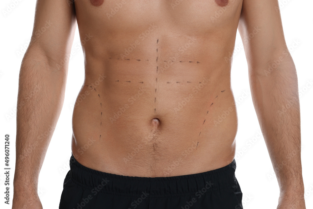 Fit man with marks on body against white background, closeup. Weight loss surgery