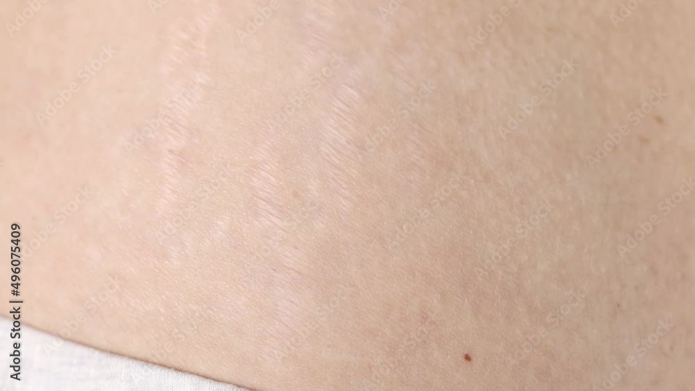 Human body with scars and stretch marks close-up. Violation of skin elasticity. Human body with scars and stretch marks close-up. Violation of skin elasticity.