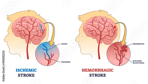 Ischemic vs hemorrhagic head stroke anatomical comparison outline diagram. Labeled educational scheme with medical brain clot, ruptured blood vessel and anoxia after thrombus vector illustration.