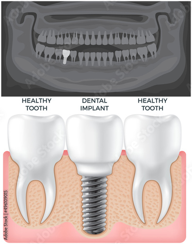 Black and white x-ray of jaw above human gum with normal teeth and dental implant. Tooth after medical procedure, dental treatment. Surgical implant in oral cavity. Radiograph with prosthesis