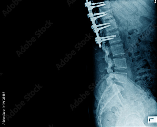 Lateral view of structure bone with internal fixation for prevent compression spine bone photo