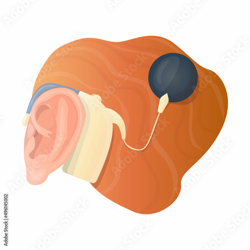 Vector isolated illustration with an ear and a hearing aid, where the sound processor is attached with a pin to the temporal bone. Concept of treatment of hearing loss, problems, otology.