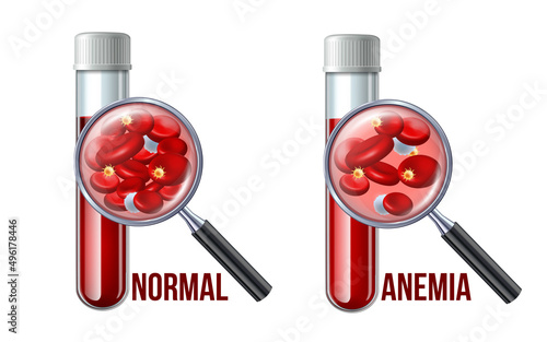 Iron deficiency anemia.The difference of Anemia amount of red blood cell and normal.