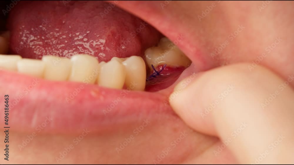 Dentist demonstrates surgical sutures on gum during implantation of implants. Closeup of