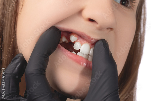 A doctor in black medical gloves examines the oral cavity of a little cute girl. Crooked teeth. Studio photo on a white background.