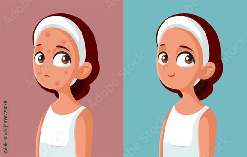 Young Girl Before and After Acne Treatment Vector Illustration