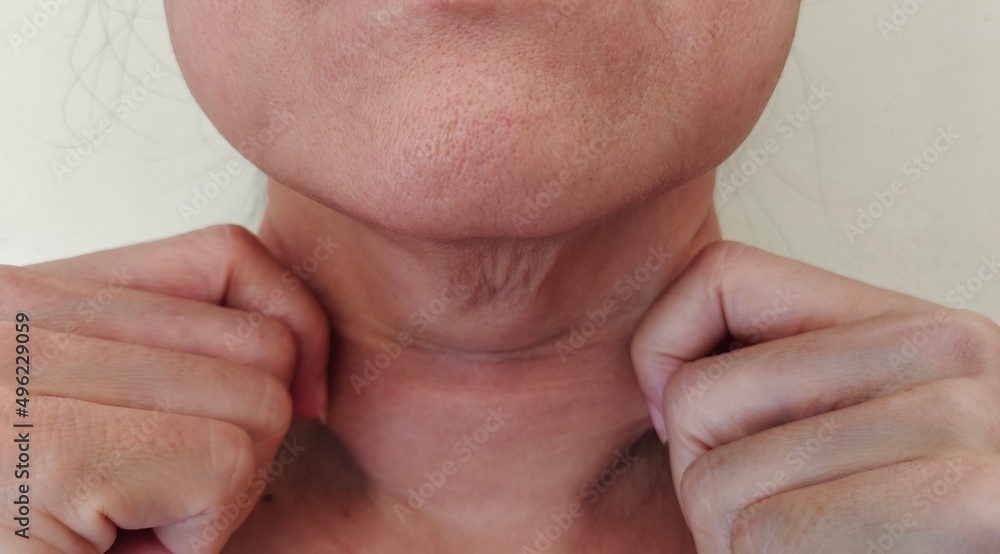 Naklejka premium Portrait showing the fingers squeeze flabbiness hanging beside the neck, problem wrinkled and cellulite under the chin of the woman, concept health care.