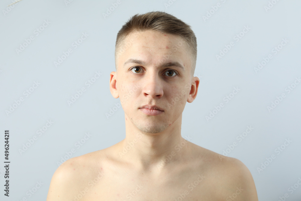 Young man with problem face skin on light background Young man with problem face skin on light background