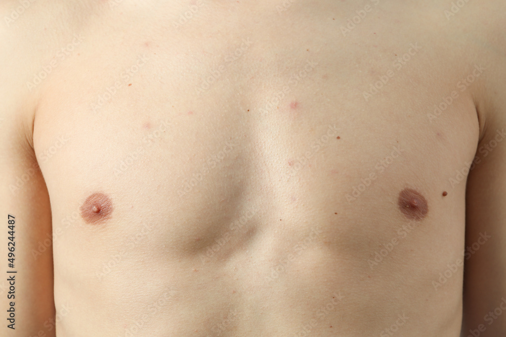 Concept of skin problems, breast of young man Concept of skin problems, breast of young man
