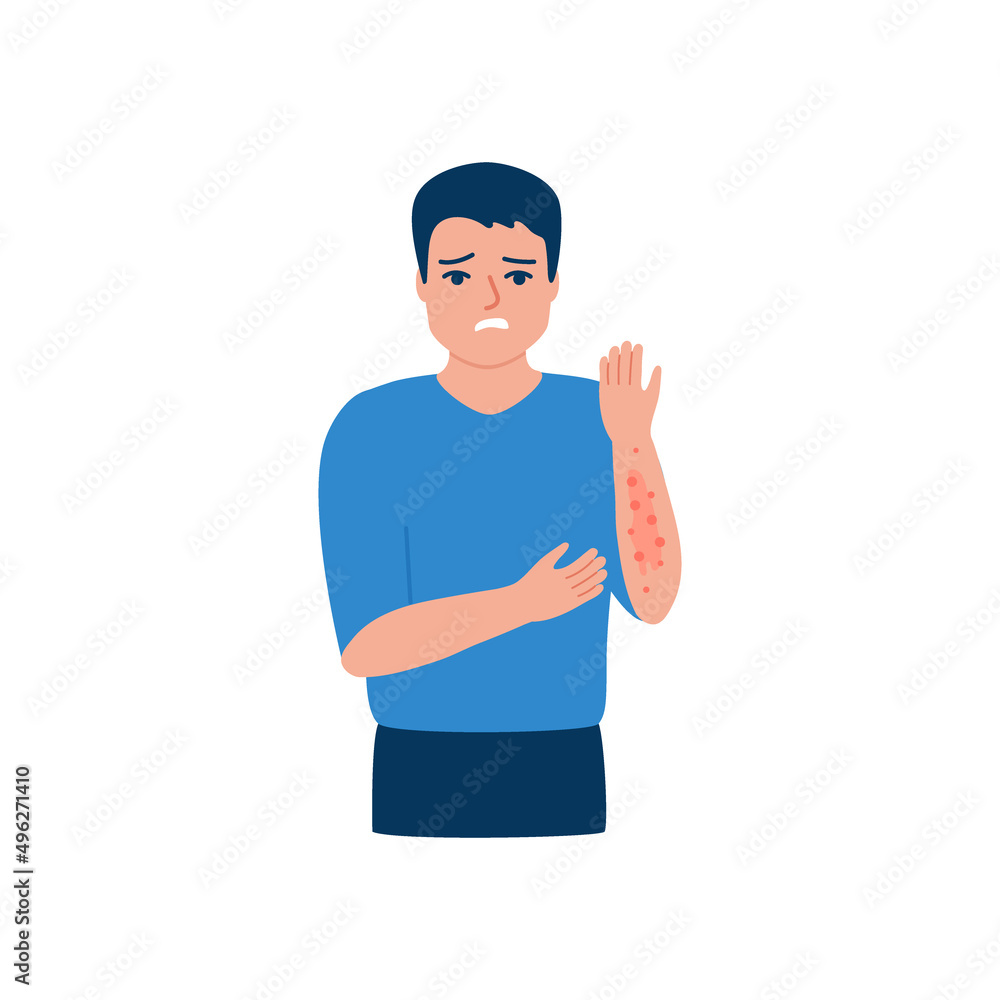 Man scratching arm, rash, allergy on hand, acne on skin. Male suffering ...