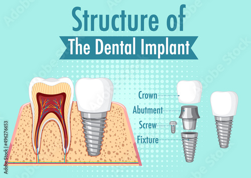 Infographic of human in structure of the dental implant